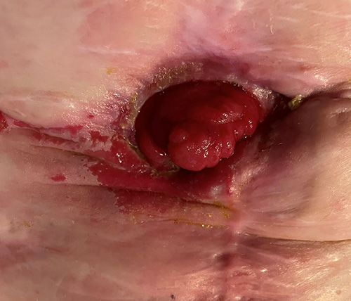 image of fistula after 4 days of using the ostoform seal with flowassist