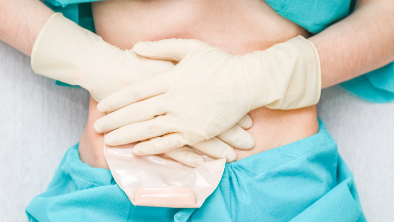 image of patient wearing scrubs and placing two hands over abdomen. hands are covering an ostomy pouch