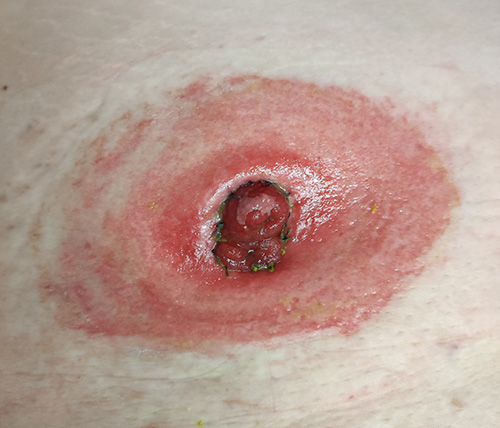 image of inflamed skin around ileostomy due to pancaking