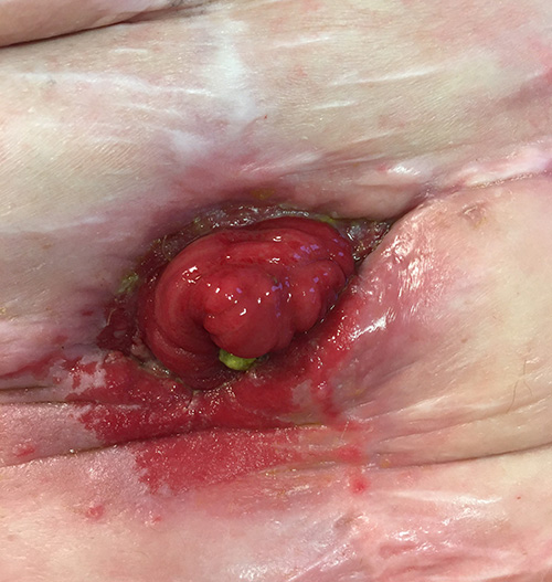 image of fistula with raw skin around the fistula