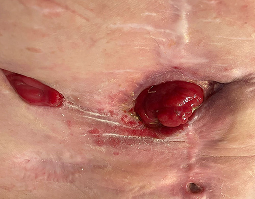 image of fistula after eleven days of using the ostoform seal with flowassist