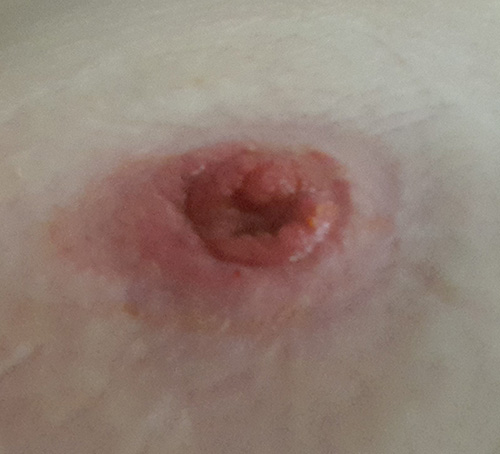 Image of skin around ileostomy after using the ostoform seal with flowassist