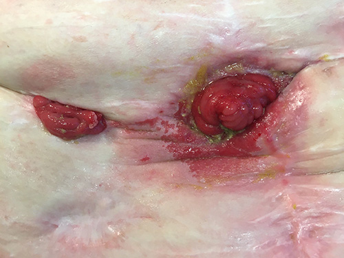 image of fistula after 2 days of using the ostoform seal with flowassist