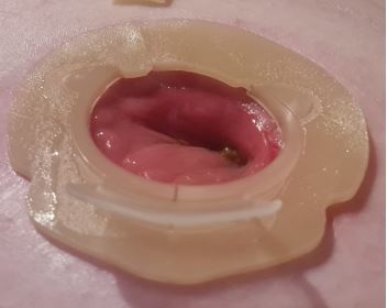 ileostomy stoma fitted with ostoform seal with flowassist to help prevent pancaking